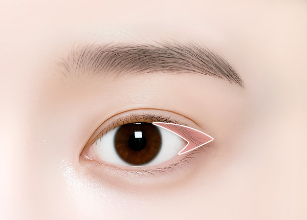 뒤트임