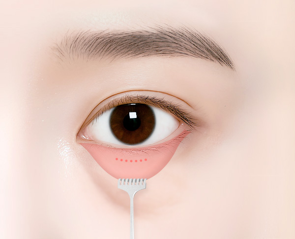 눈밑지방재배치