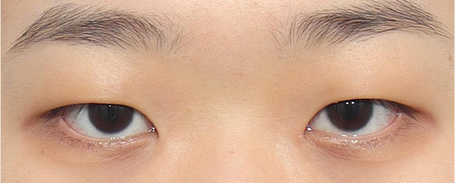 눈매교정 전후사진 전