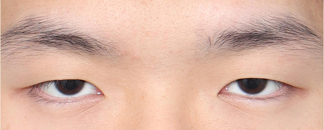 눈매교정 전후사진 전
