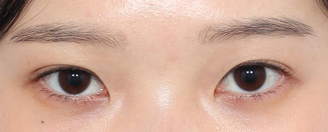 자연유착 재수술 전후사진 후