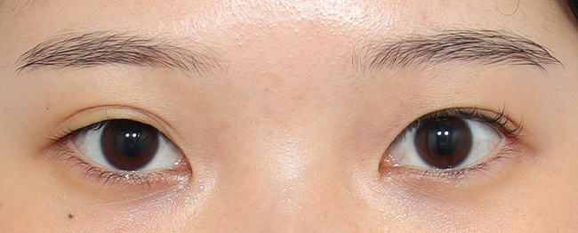 자연유착 재수술 전후사진 전