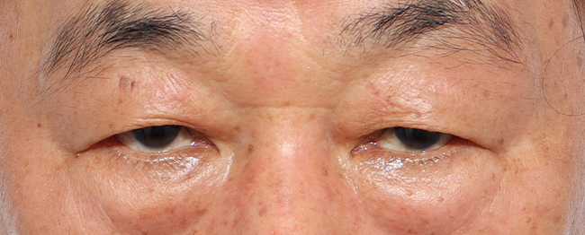눈썹하거상 전후사진 전