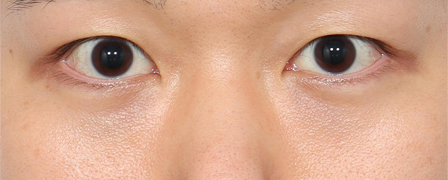 눈밑지방재배치 전후사진 후
