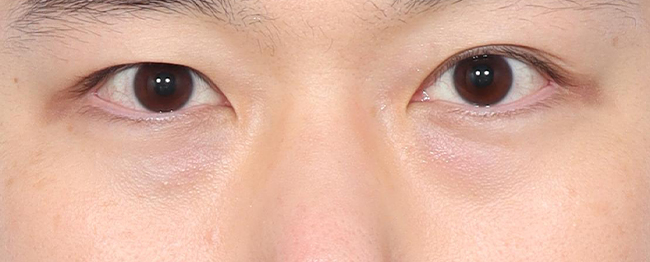 눈밑지방재배치 전후사진 전
