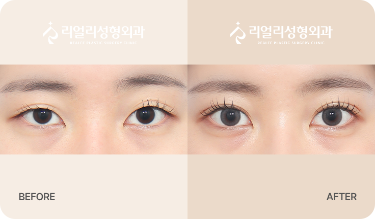 비절개 쌍꺼풀 전후사진