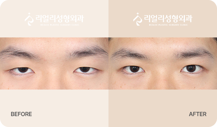 절개 눈매교정 전후사진