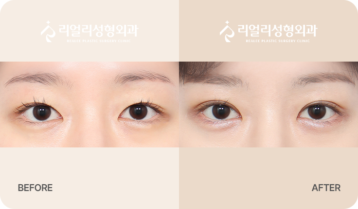 절개 쌍꺼풀 전후사진