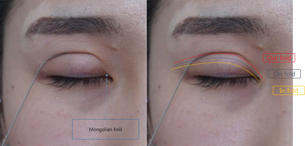 Close-up of a closed eye showing eyelid folds with color-coded labels: Mongolian fold, Out fold, On fold, and In fold.
