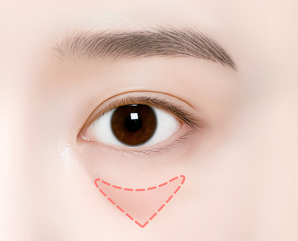 sub_fat injection