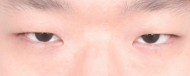 Close-up of a person’s eyes and the surrounding skin, showing the upper nose area in a neutral expression.