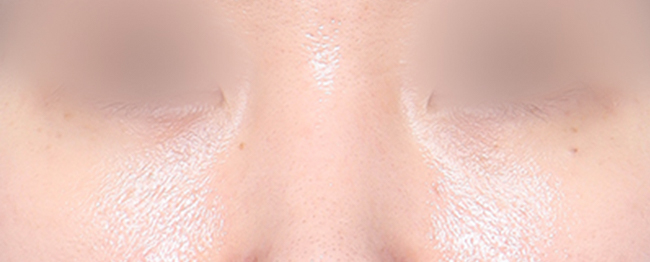Close-up of a shiny facial surface around the nose with visible pores.
