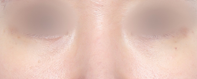 Close-up of a person's nose and surrounding skin with the eyes blurred for privacy.