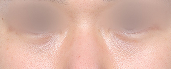 Close-up of a person's face with eyes closed, focusing on the eyelids and nose area.