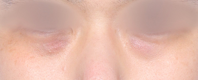 Close-up of a person’s face with eyes closed, showing relaxed eyelids and skin around the nose.