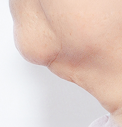 Close-up of a person's chin and neck with a loose fold of skin along the jawline.