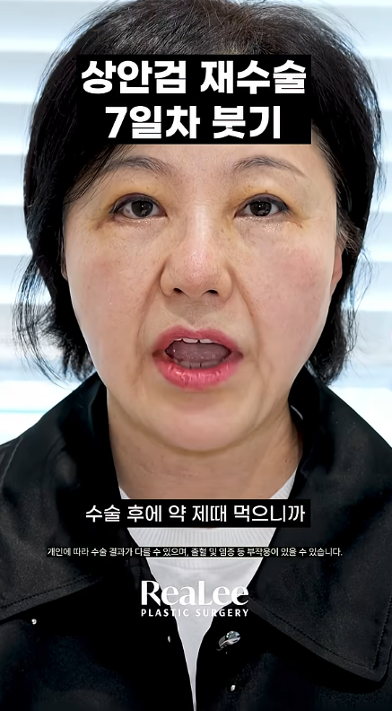 Video thumbnail of a woman discussing 7 days after eyelid redo surgery; Korean captions read '상안검 재수술 7일차 보기' and '수술 후에 약 제대 먹으니까'