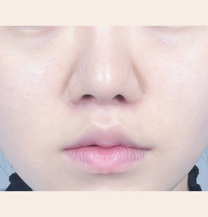 Close-up of a person’s lower face, showing the nose and pink lips with smooth skin.