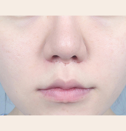 Close-up of a person's nose and mouth area, highlighting skin texture and visible pores.