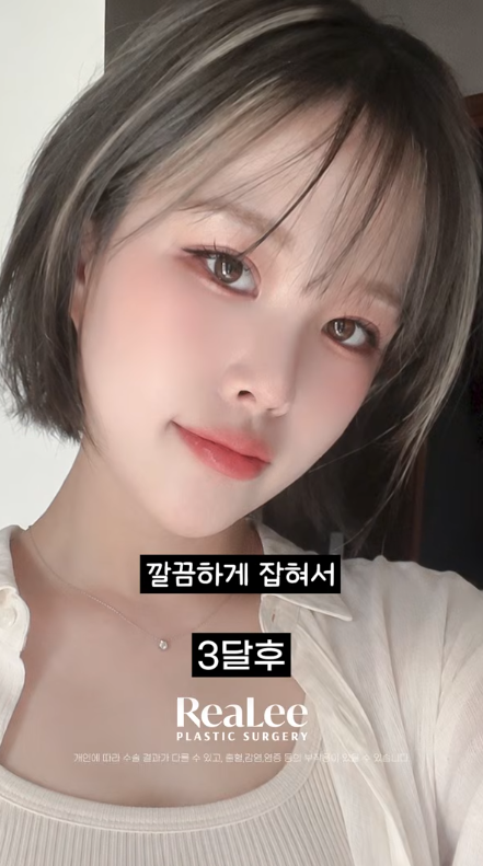 Close-up selfie of a young woman with short hair and light makeup; Korean caption reads '3 months later' advertising RealEe Plastic Surgery.